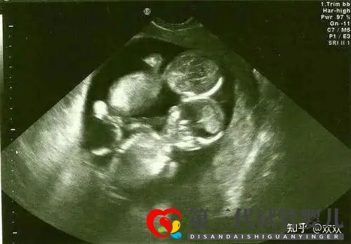 多年不孕,成都三代試管一次成功雙胎男寶(圖5) 多年不孕,成都三代試管一次成功雙胎男寶(圖5)