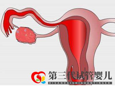 子宮肌瘤做俄羅斯試管嬰兒的成功率高嗎？(圖1)