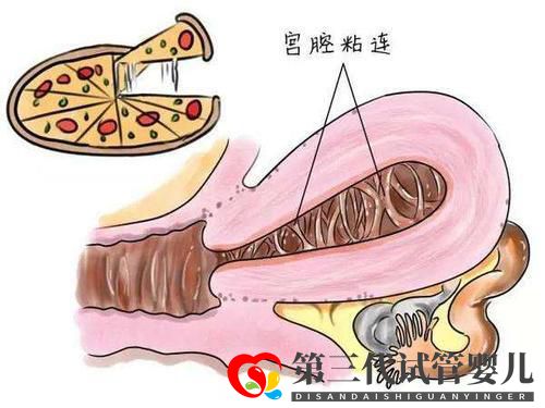 子宮粘連可以做試管嬰兒嗎？成功率高不高？(圖2)