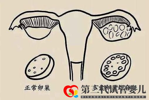 多囊促排懷孕成功率大嗎？(圖1)
