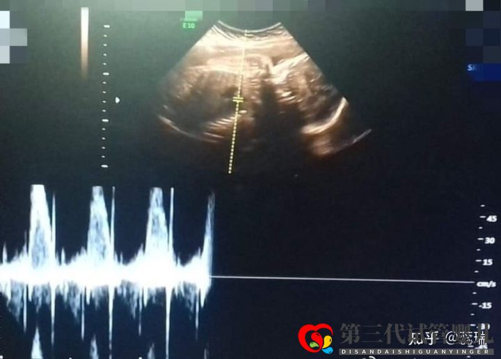 我終于懷上了辛酸三代試管經(jīng)歷大家接好孕(圖4) 我終于懷上了辛酸三代試管經(jīng)歷大家接好孕(圖4)