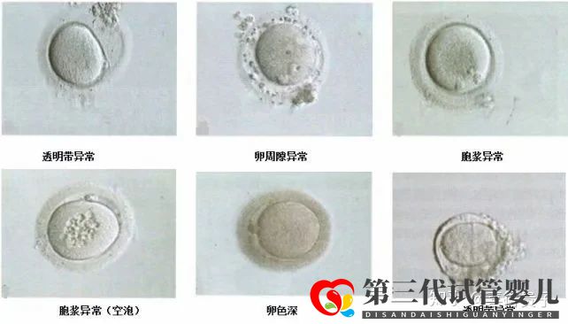 夫妻染色體正常,但胚胎染色體異常,什么原因引起(圖10) 夫妻染色體正常,但胚胎染色體異常,什么原因引起(圖10)