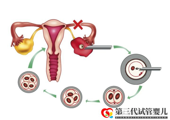 試管嬰兒1代、2代、3代、4代哪個(gè)最好真實(shí)操作過...(圖8)