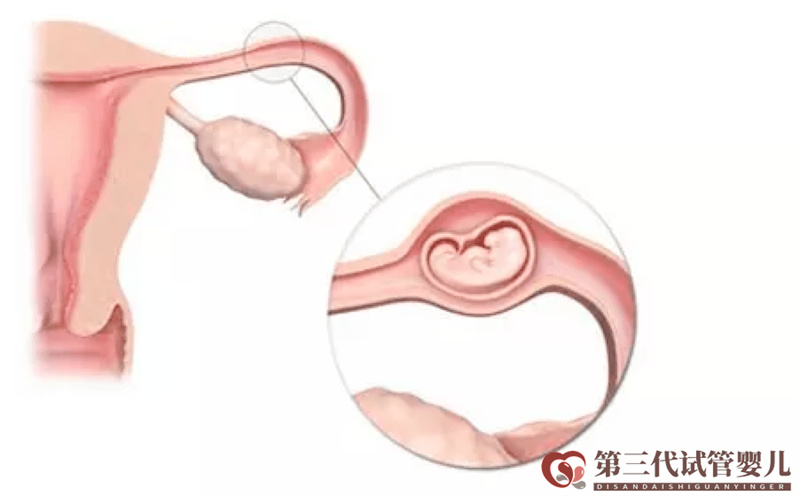 做試管嬰兒是不是可以避免宮外孕了？醫(yī)生告訴你沒那么簡單！(圖1)