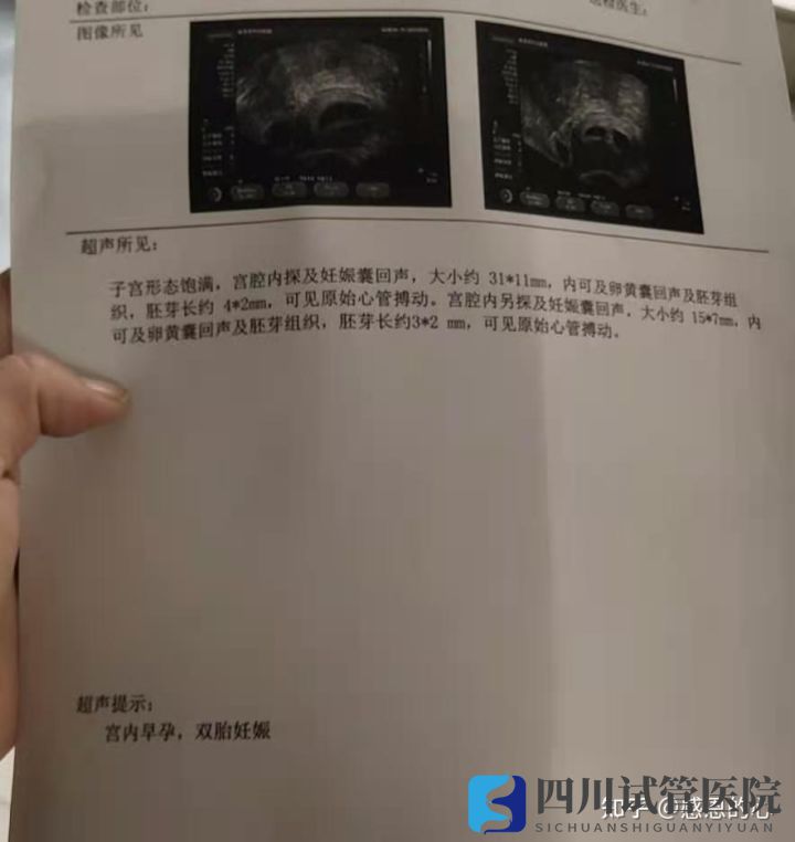我在成都做三代試管的經(jīng)歷(標(biāo)圖接好孕)(圖4) 我在成都做三代試管的經(jīng)歷(標(biāo)圖接好孕)(圖4)